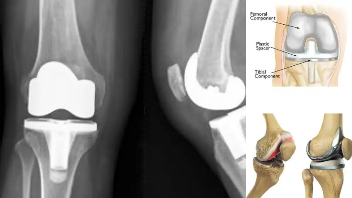 Top 5 mistakes after knee replacement